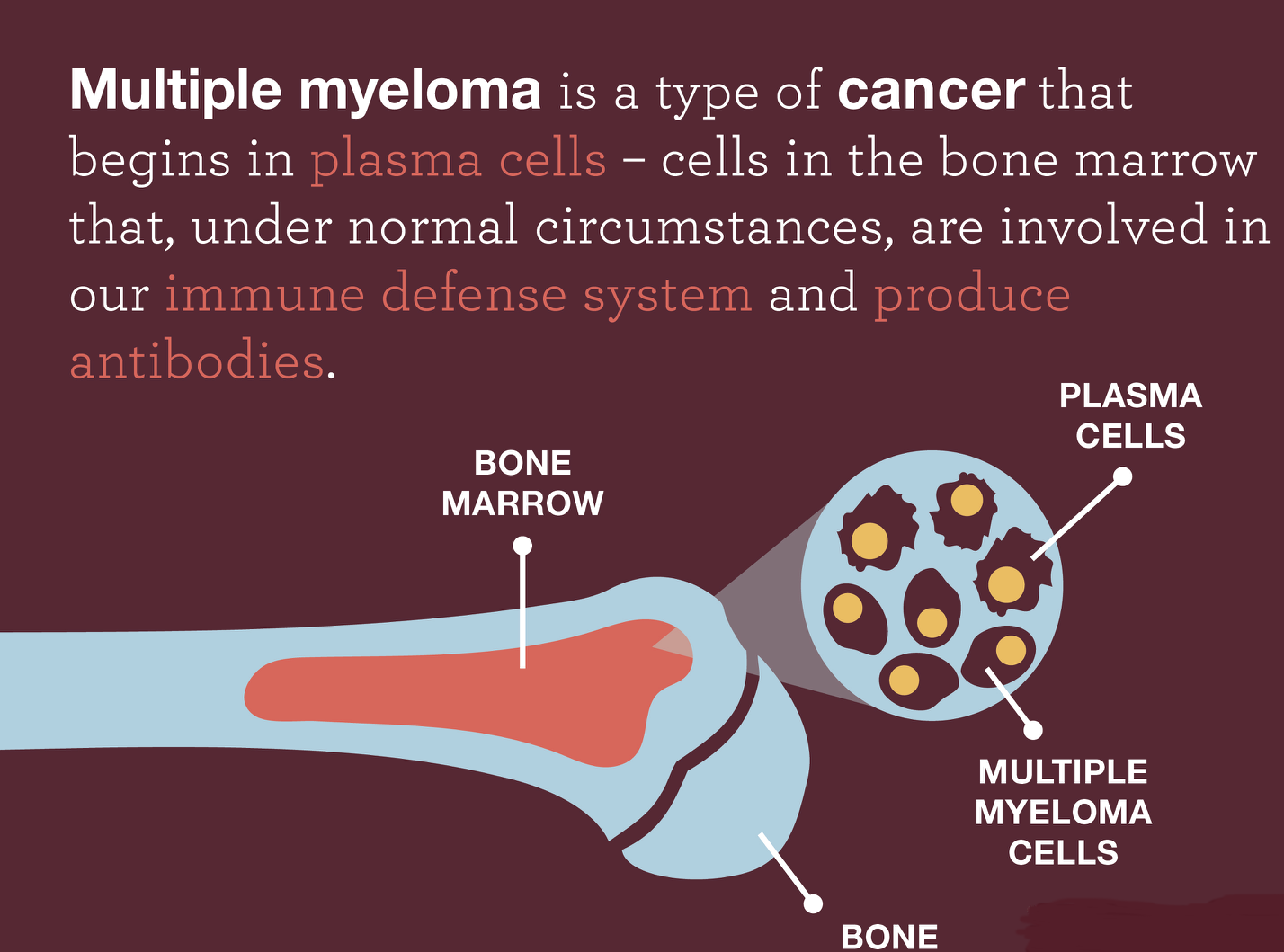 case study of multiple myeloma